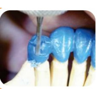 Віск BMS Dental моделювальний універсальний, синій, 100г